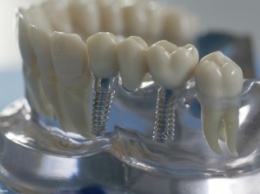 Ученые напечатали на 3D-принтере антибактериальные зубные импланты