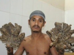 В Бангладеш успешно прооперировали «человека-дерево»