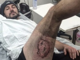 Велосипедист в Австралии лишился кожи после взрыва iPhone в кармане [фото]
