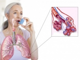 Британцы тестируют новый препарат против астмы