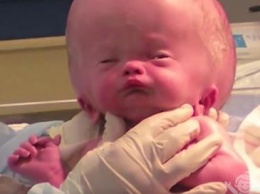 Малыш родился с огромной опухшей головой. Но через полтора года врачи глазам не верят, глядя на него