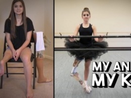 Жажда жизни. 15-летняя балерина танцует, несмотря на ампутированную ногу