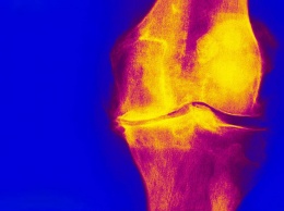 Шотландцы научились прогнозировать терапию ревматоидного артрита