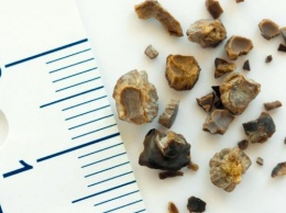Красноярские ученые создали нейросеть, помогающую в борьбе с камнями в почках