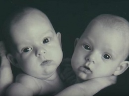 Чтобы разделить этих близняшек, медики трудились 12 часов. Вот какими стали малышки через 10 лет