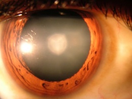 Ученые: Найден способ вылечить катаракту с помощью глазных капель