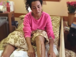 Настя Каменских показала ужасный шрам после операции на ноге