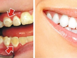 Будьте сами себе дантистом! Вот как снять налет с зубов всего за 5 минут!