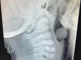 Этот рентгеновский снимок 5-летнего ребенка показывает, почему детям нельзя есть без присмотра
