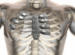 В Испании врачи провели первую в мире операцию по пересадке ребер, напечатанных на 3D-принтере