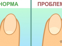 Вот о каких заболеваниях расскажут лунки на ногтях