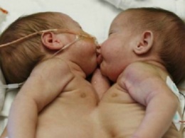 Они родились с одной грудной клеткой на двоих. Родители приняли решение их разделить, и спустя 2 года их не узнать!
