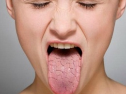 Медики рассказали, о каких болезнях говорит сухость во рту