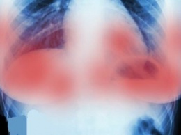 Ученые в Амстердаме недавно уничтожили опухоль молочной железы в течение 11 дней без химиотерапии!