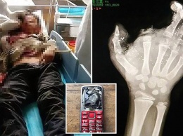12-летний мальчик потерял палец и почти ослеп, когда его телефон взорвался