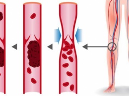 8 продуктов, которые разжижают кровь и способны предотвратить тромбоз