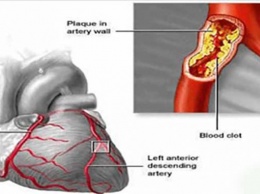 Сохраните здоровье сердца, почек и мозга: очистите свои артерии, используя эти 3 компонента!