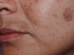 Как вывести коричневые пятна на лице: всего лишь два простых компонента