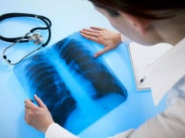 В Крыму снижается уровень заболеваемости туберкулезом