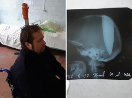 ''Чтобы голова дышала'': россиянин с кинжалом в черепе пожаловался на насморк. Шокирующее видео