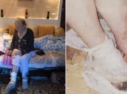 В РФ умерла пенсионерка, которой ампутировали здоровую ногу