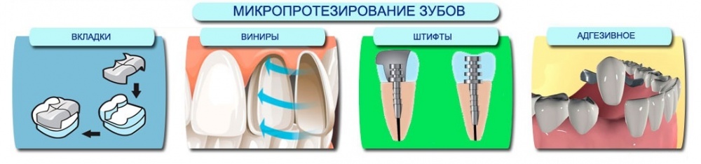 Виниры или микропротезирование зубов – современный способ восстановления зубного ряда