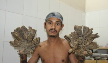 В Бангладеш успешно прооперировали «человека-дерево»