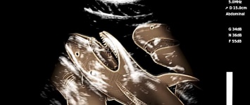 На УЗИ беременной акулы детеныши походят на «чужих»