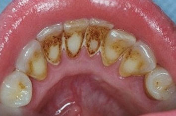 Как удалить зубной налет без визита к стоматологу!