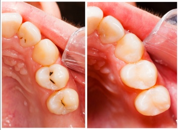 Ученые создали пломбы, обновляющие поврежденные зубы