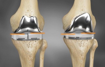 Ученые при помощи 3D принтера создали полноценный протез сустава