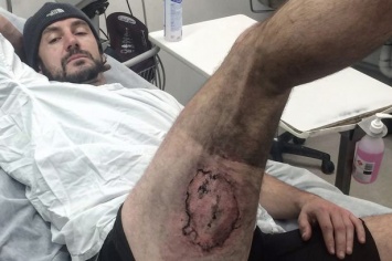 Велосипедист в Австралии лишился кожи после взрыва iPhone в кармане [фото]