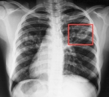 Где и от чего можно заразиться туберкулезом