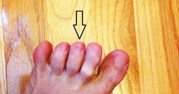 Простая проверка между пальцами на ногах может спасти вам жизнь, уверяют доктора!