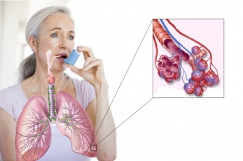 Британцы тестируют новый препарат против астмы