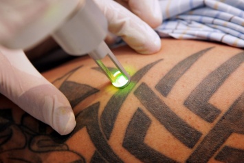 Ученые: Лазерное лечение является более безопасным для удаления татуировок
