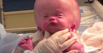 Малыш родился с огромной опухшей головой. Но через полтора года врачи глазам не верят, глядя на него