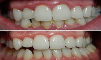 Как удалить зубной налет за 5 минут естественным способом без визита к стоматологу!
