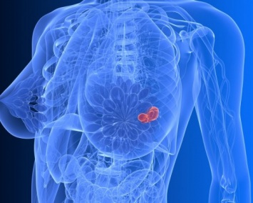 В наше время даже у 30-летних находят рак груди