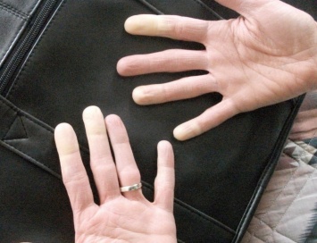 Медики могут определять наличие сердечных заболеваний по пальцам