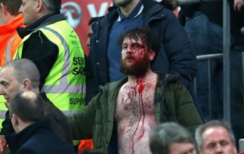 Английскому болельщику разбили лицо во время матча против Шотландии