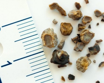 Красноярские ученые создали нейросеть, помогающую в борьбе с камнями в почках
