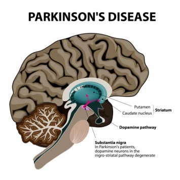 Ученые придумали способ справиться с болезнью Паркинсона