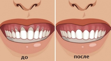 Вы заметили оголение шейки или корня зуба? Немедленно начинайте лечение - 6 натуральных рецептов!