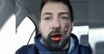 У американца во рту взорвалась электронная сигарета: мужчина лишился 7 зубов и получил ожог лица (Фото)