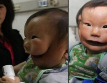 Ребенок с крайне редким дефектом появился на свет в Китае 8 лет назад