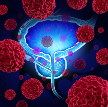 Ученые: При раке предстательной железы МРТ действует эффективнее биопсии