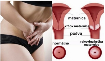 До появления рака шейки матки, тело предупреждает заранее. Не игнорируйте эти 5 сигналов!