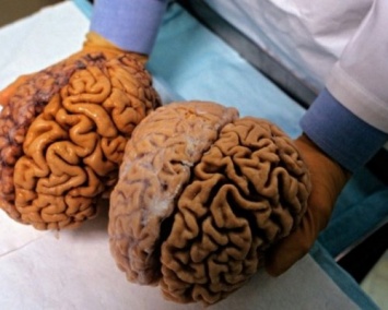 Ученые призывают больных депрессией людей пожертвовать свой мозг науке