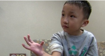 Хирурги отрастили ребенку большой палец на руке